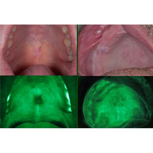 Mild_Moderate Dysplasia